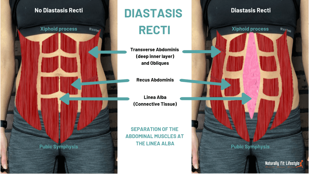 Diastasis Recti Rectus Abdominis Muscle Abdomen Physical Therapy Png ...