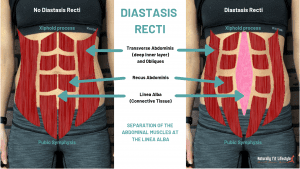 What is diastasis recti?