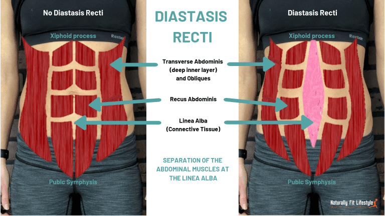 What Is Diastasis Recti 